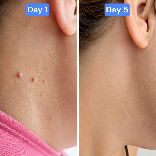 TagBuddy™ | Skin Tag Remover Kit